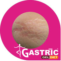 gastric_gell